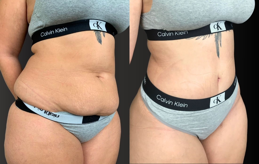 52967 Abdominoplastia 45º