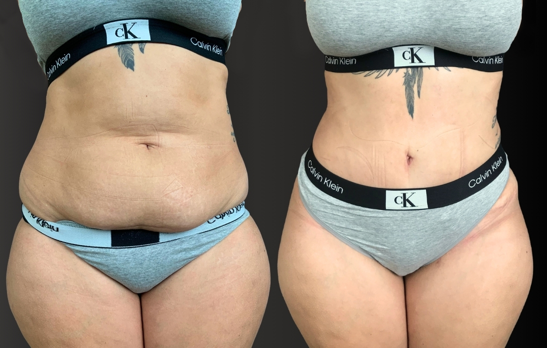 Novos casos site - 52967 Abdominoplastia Frente