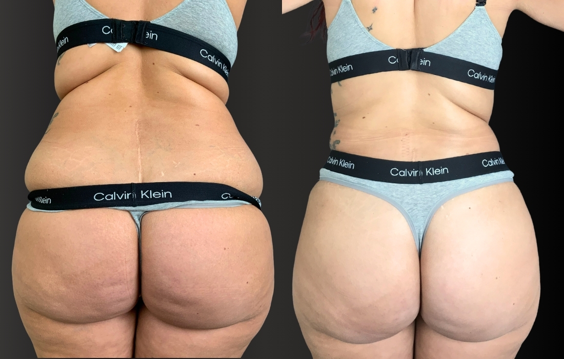 52967 Abdominoplastia Trás