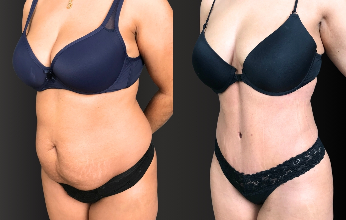 Abdominoplastia (2)